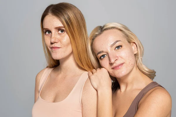 Hübsche Frauen mit Problemhaut blicken in die Kamera, während sie isoliert auf grau stehen — Stockfoto