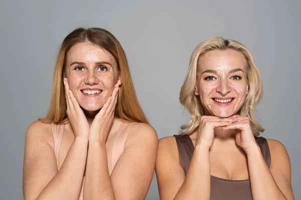 Lächelnde Freunde mit Hautproblemen posieren und schauen isoliert in die Kamera auf grau — Stockfoto