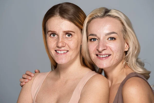 Портрет блондинки с проблемной кожей обнимающей улыбающейся подруги с веснушчатым лицом, изолированной на сером — стоковое фото