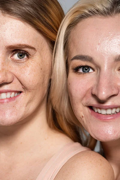 Vista recortada de mujeres sonrientes con problemas de piel mirando a la cámara aislada en gris - foto de stock