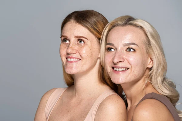Lächelnde Models mit Hautproblem schauen vereinzelt auf grau — Stockfoto