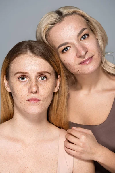 Mujeres con acné y piel pecosa posando juntas aisladas sobre gris - foto de stock
