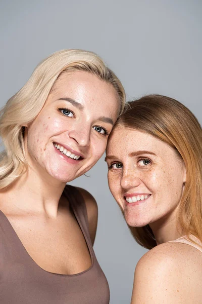 Amici felici con problemi di pelle guardando la fotocamera mentre sorridono isolati sul grigio — Foto stock