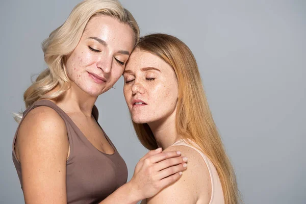Modelos com problemas de pele fechando os olhos enquanto posam juntos isolados em cinza — Fotografia de Stock
