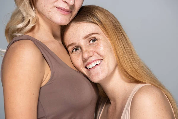 Positive freckled woman standing near friend with skin issue isolated on grey — Stock Photo