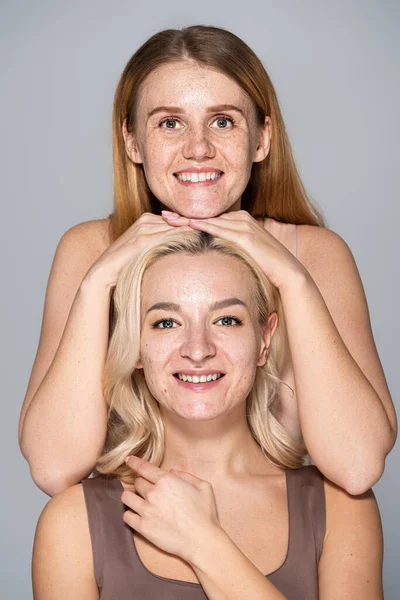 Mujer pecosa positiva posando cerca de un amigo con acné aislado en gris - foto de stock