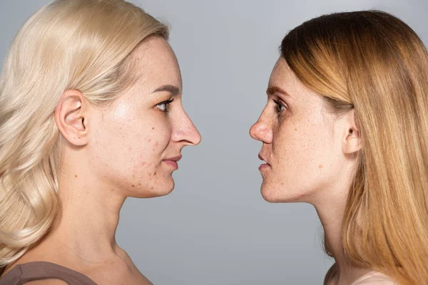 Вид збоку моделей з проблемною шкірою, що дивляться один на одного, стоячи обличчям до обличчя ізольовано на сірому — стокове фото