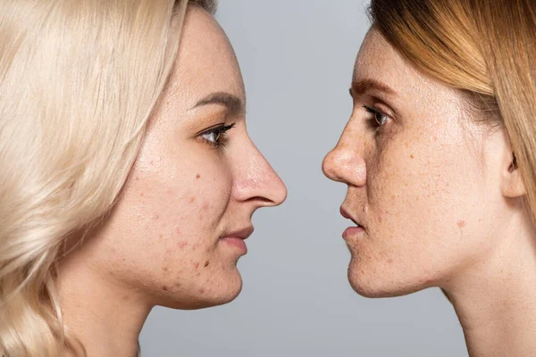 Perfil de las mujeres con problemas de piel de pie cara a cara aislado en gris - foto de stock