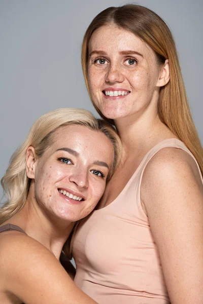 Веселі жінки з проблемами зі шкірою дивиться на камеру ізольовано на сірому — стокове фото