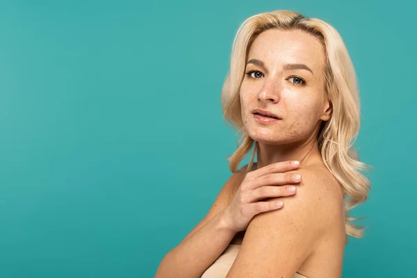 Young woman with acne on face touching shoulder isolated on turquoise — Stock Photo