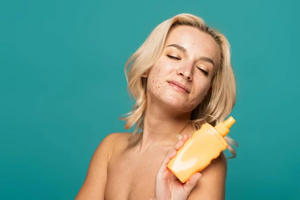 Mulher satisfeita e loira com acne segurando garrafa com protetor solar isolado em turquesa — Fotografia de Stock