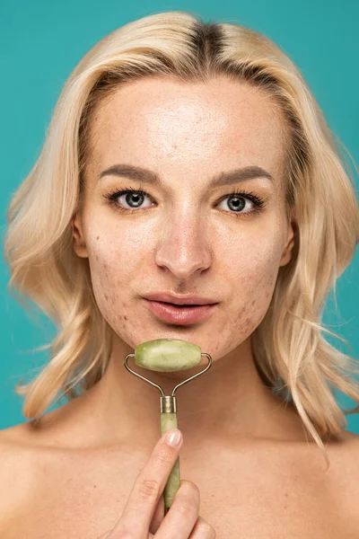 Primer plano de mujer rubia con acné sosteniendo rodillo de jade cerca de la cara aislado en turquesa - foto de stock