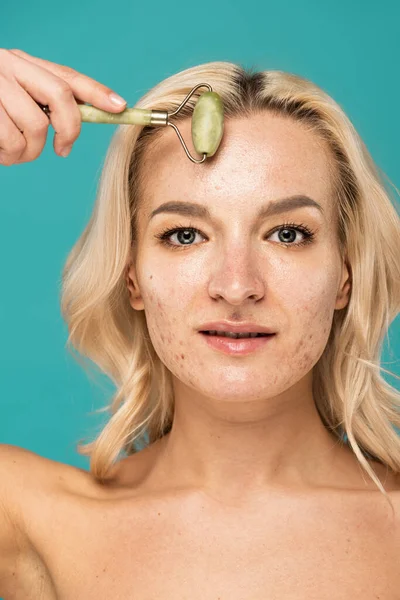 Close up of blonde woman with acne lifting face with jade roller isolated on turquoise — Stock Photo