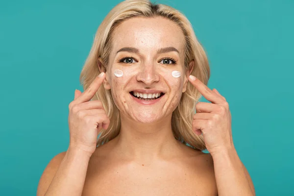 Mulher alegre com acne aplicando creme e apontando com os dedos no rosto isolado em turquesa — Fotografia de Stock