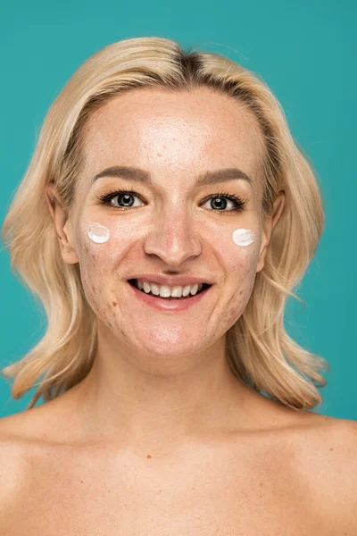 Mujer feliz con problemas de piel aplicando crema de tratamiento en la cara aislada en turquesa - foto de stock