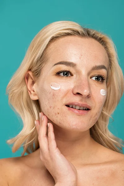 Femme blonde avec des problèmes de peau appliquer la crème de traitement sur le visage isolé sur turquoise — Photo de stock