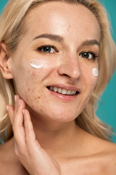 Gros plan de femme gaie avec des problèmes de peau appliquer la crème de traitement sur le visage isolé sur turquoise — Photo de stock