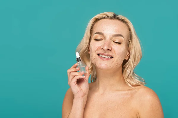 Cheerful woman with acne on face holding bottle with serum isolated on turquoise — Stock Photo