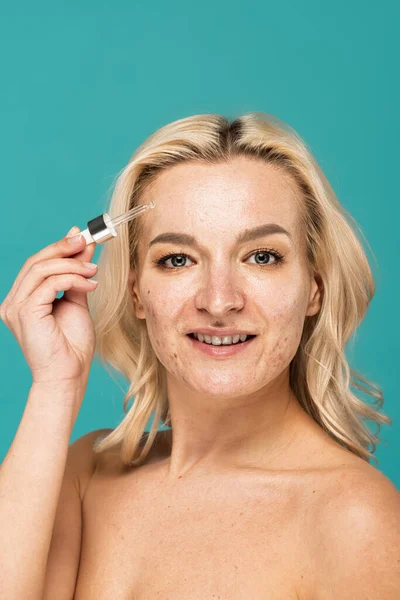 Happy woman with acne on face holding pipette with serum isolated on turquoise — Stock Photo