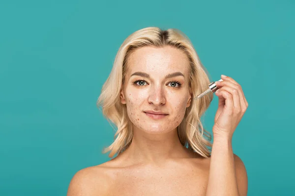 Blonde woman with acne on face holding pipette with moisturizing serum isolated on turquoise — Stock Photo