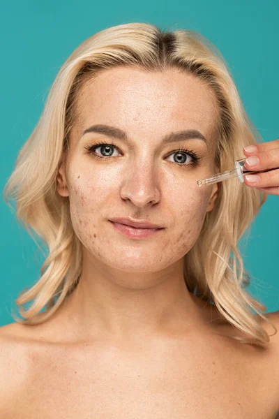 Blondine mit Akne im Gesicht hält Tropfer mit Behandlungsserum isoliert auf Türkis — Stockfoto