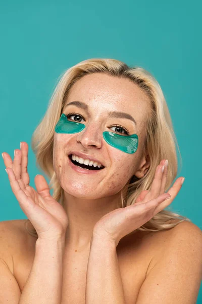 Mujer excitada con acné y parches para los ojos hidratantes sonriendo aislado en turquesa - foto de stock