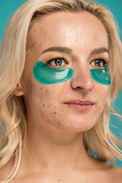 Close up of blonde woman with acne and moisturizing eye patches isolated on turquoise — Stock Photo