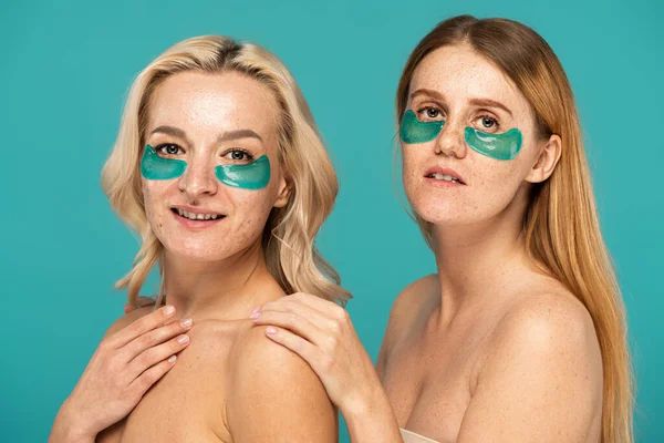 Young women with different skin conditions and patches under eyes posing isolated on turquoise — Stock Photo