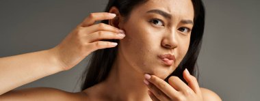 concerned young asian woman with bare shoulders touching her face with acne on grey backdrop, banner clipart