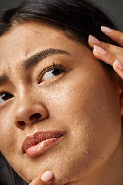 close up photo of concerned young asian woman with brunette hair touching her face with acne