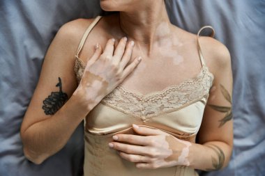 Vitiligo 'su ve dövmesi olan genç bir kadın yatağında ipeksi bir gecelik giyiyor..