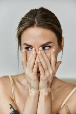 Vitiligo 'su olan genç bir kadın yatak odasında oturuyor. Yüzünü kapatırken elleri yüzünü çeviriyor..
