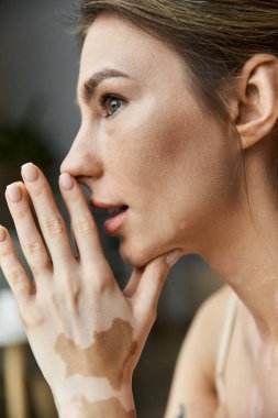 Vitiligo 'su olan genç bir kadın yatak odasında oturuyor, eli çenesinde dinleniyor, düşüncelere dalmış..