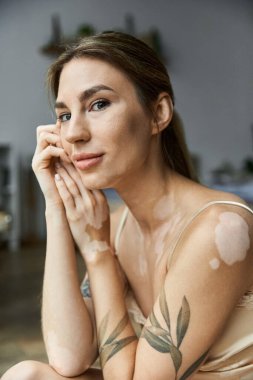 Vitiligo ve yaprak dövmeli genç bir kadın yatak odasında oturuyor, kollarını kavuşturmuş, düşünceli bir ifadeyle..