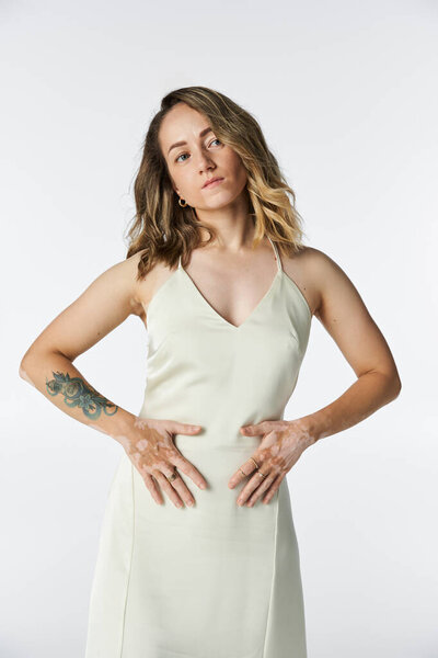 Красивая молодая женщина с витилиго уверенно демонстрируя свою уникальную красоту в светлом платье.