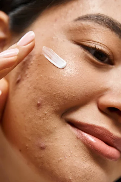 Primo piano colpo di giovane donna asiatica con problemi di pelle applicando crema trattamento acne sul viso, verticale — Foto stock