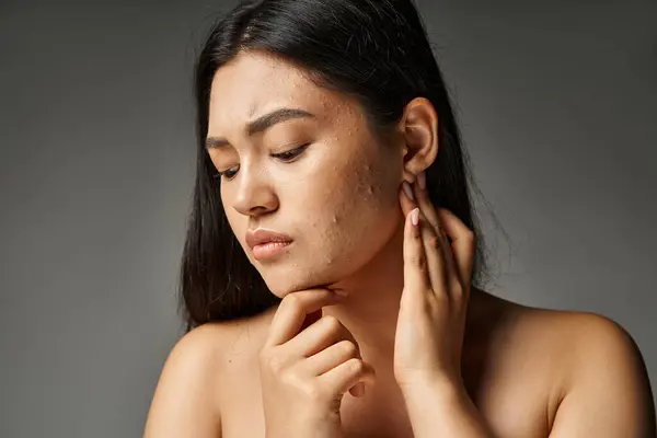 Triste jovem asiático mulher com nua ombros e acne propenso pele no fundo cinza, pele questões conceito — Fotografia de Stock