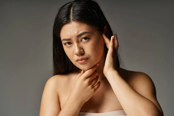 Беспокойная молодая азиатская женщина с голыми плечами и акне склонной кожей на сером фоне, проблемы с кожей — стоковое фото