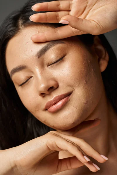 Complacido joven mujer asiática con acné propenso a la piel y los ojos cerrados sobre fondo gris, problemas de piel - foto de stock
