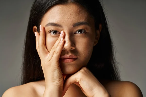 Young asian woman with skin issues and bare shoulders looking at camera on grey background — Stock Photo