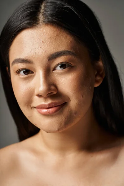 Heureux jeune asiatique femme avec des problèmes de peau et les épaules nues regardant caméra sur fond gris — Photo de stock