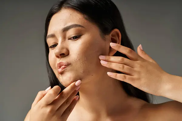 Preocupado jovem mulher asiática com cabelo morena tocando seu rosto com acne no fundo cinza — Fotografia de Stock