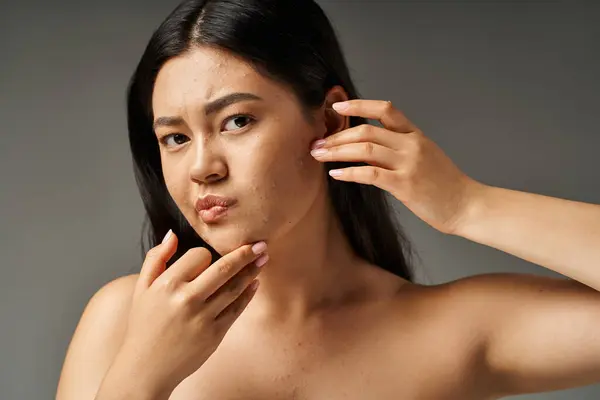 Concerned young asian woman with bare shoulders touching her face with acne on grey background — Stock Photo