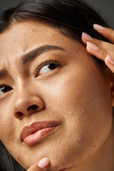 Close up photo of concerned young asian woman with brunette hair touching her face with acne — Stock Photo