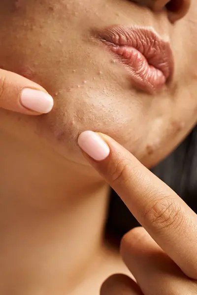 Close up photo of cropped young woman with acne prone skin popping pimple on face, vertical shot — Stock Photo