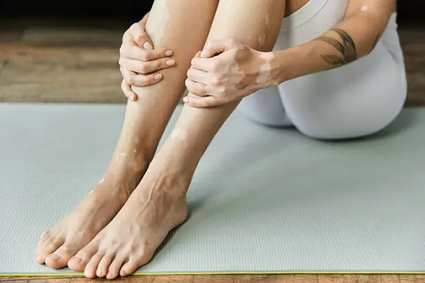 A young woman with vitiligo sits on a yoga mat in a modern apartment, her legs crossed and her hands resting on her shins. — Stock Photo