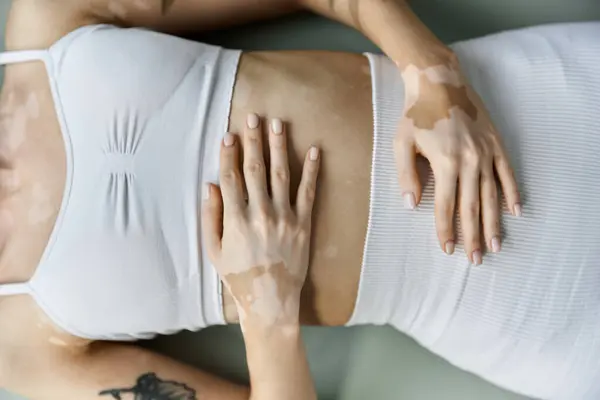 A young woman with vitiligo practices yoga in a modern apartment, focusing on self-care and mindfulness. — Stock Photo