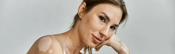 A young woman with vitiligo rests her head on her hand, gazing thoughtfully at the camera. — Stock Photo