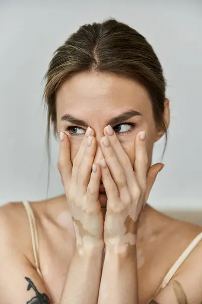 Eine junge Frau mit Vitiligo sitzt in ihrem Schlafzimmer, ihre Hände bedecken ihr Gesicht, während sie wegschaut. — Stockfoto