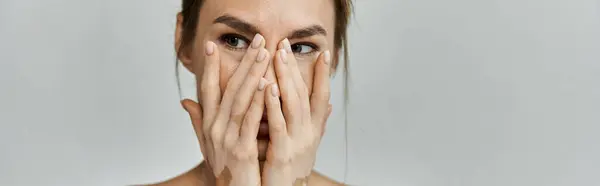 A young woman with vitiligo and a tattoo covers her face with her hands, looking away from the camera. — Stock Photo